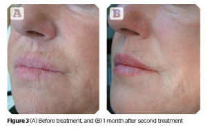 Profhilo treatment before after